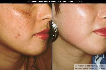 microdermabration